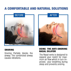 Anti-Snoring Nasal Dilators